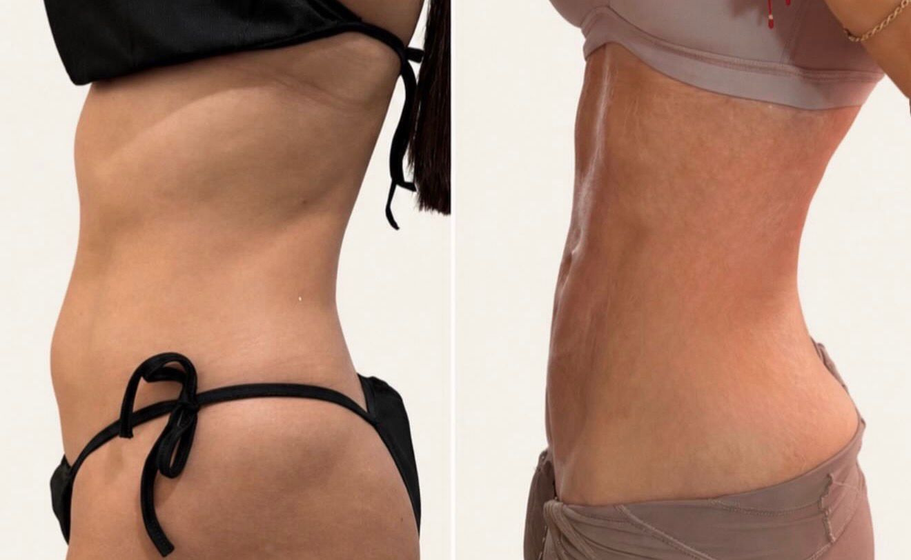 Before and after tummy transformation 2 from the Natural Contour reference gallery