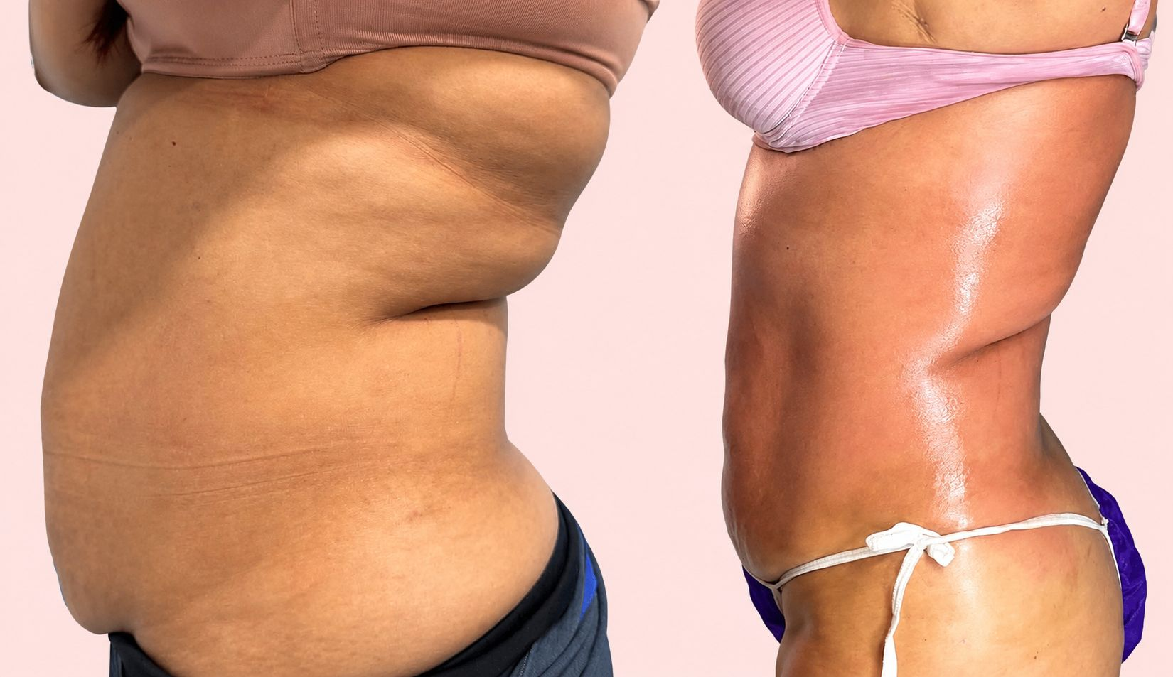 Before and after tummy transformation 5 from the Natural Contour reference gallery