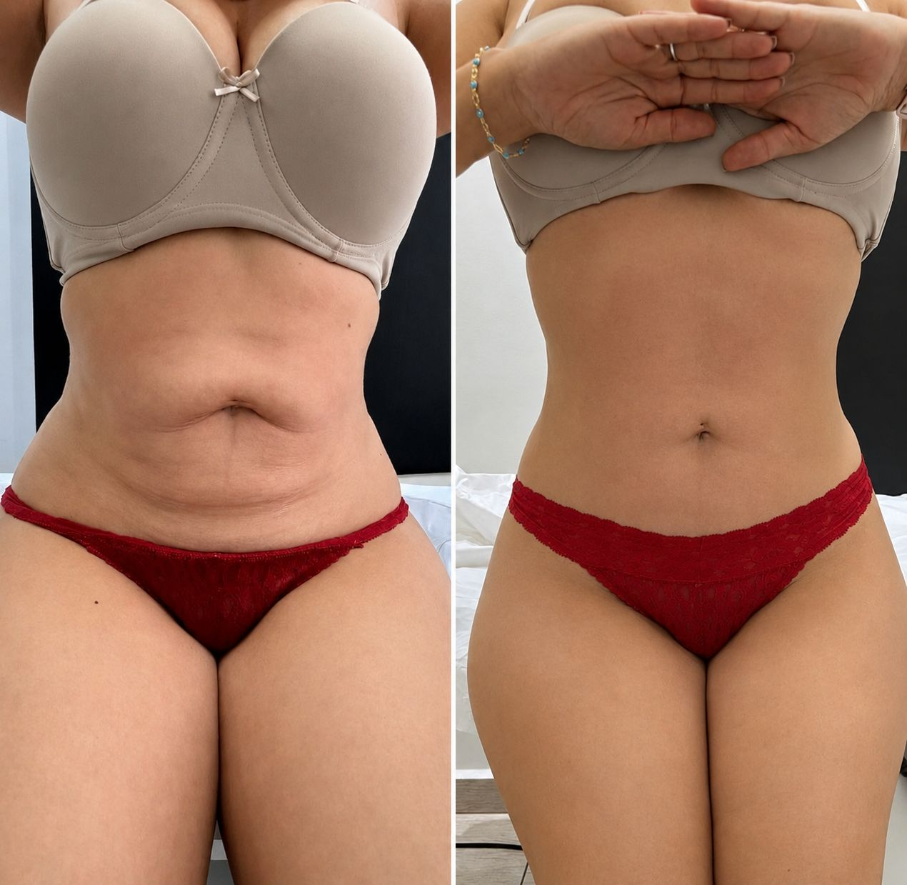 Before and after tummy transformation 1 from the Natural Contour reference gallery