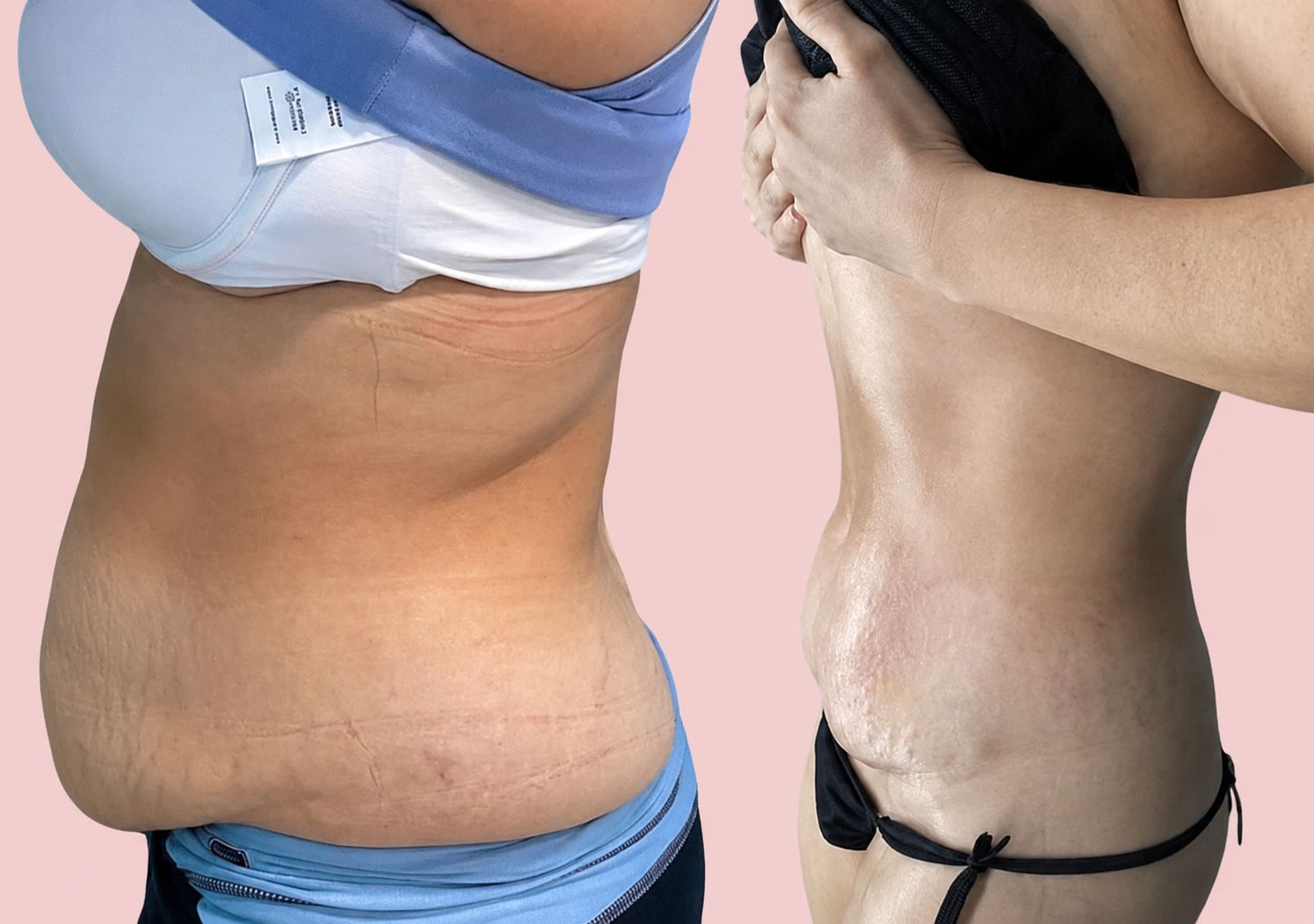 Before and after tummy transformation 4 from the Natural Contour reference gallery