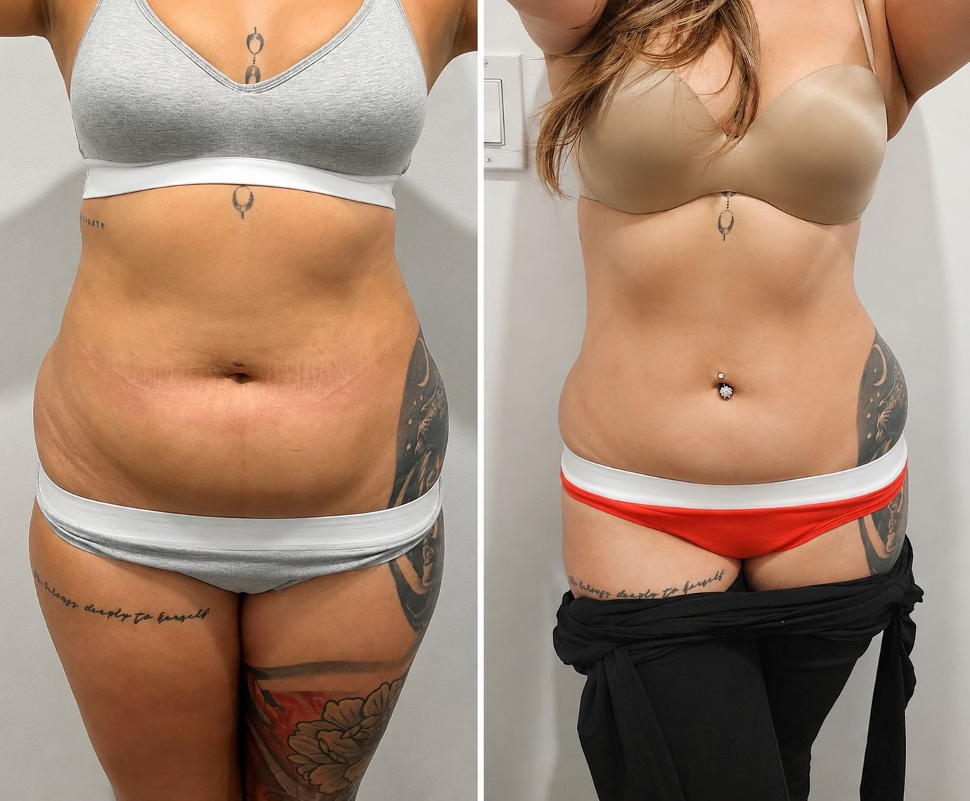 Before and after tummy transformation 6 from the Natural Contour reference gallery