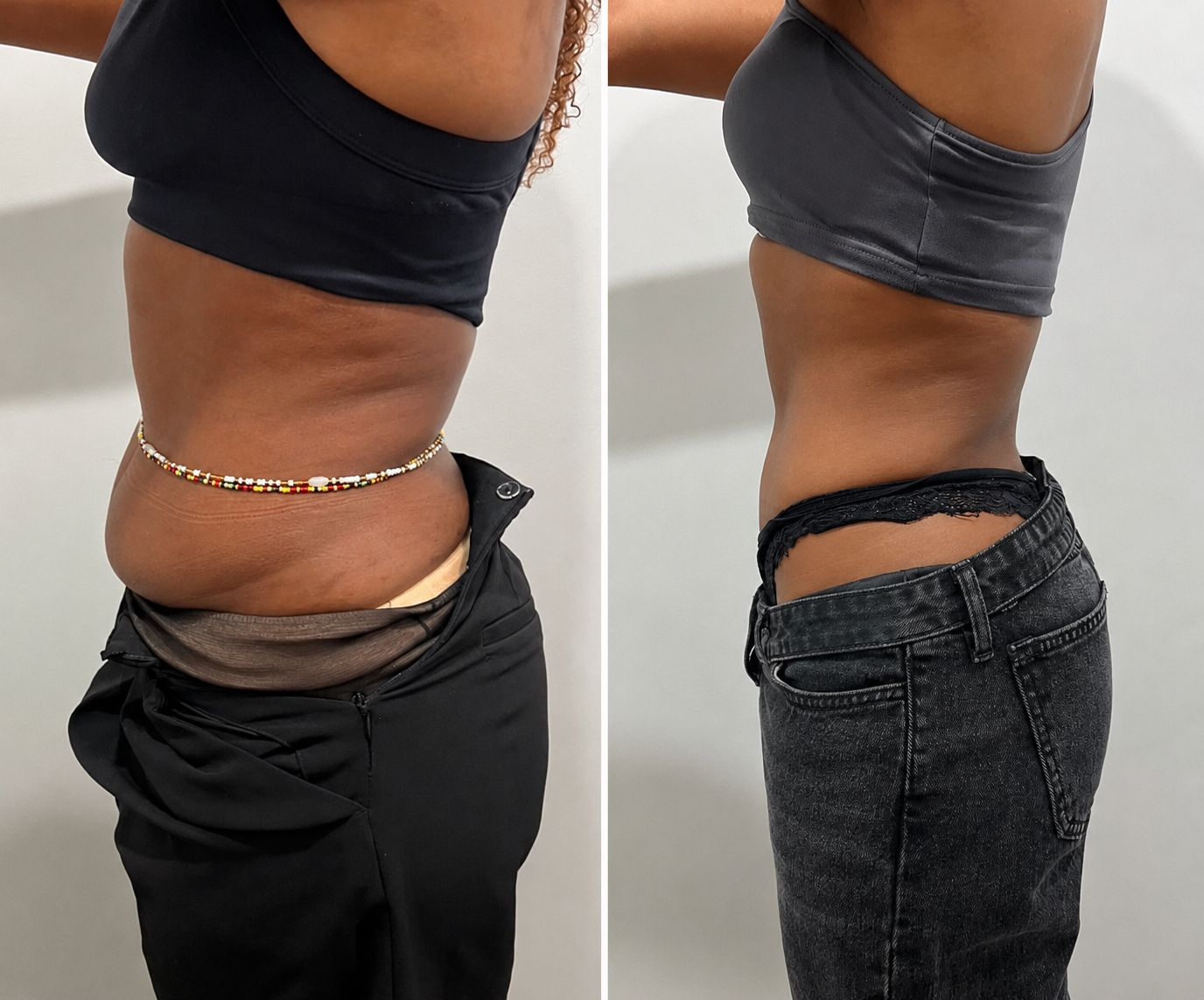 Before and after tummy transformation 3 from the Natural Contour reference gallery